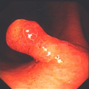 Polyp as seen on colonoscopy